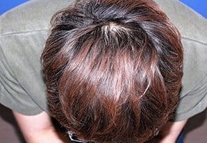 自毛植毛手術１０ヶ月後 38歳 男性 H.Y.さん頭頂部 MIRAI法 2,700株 東京 新宿院