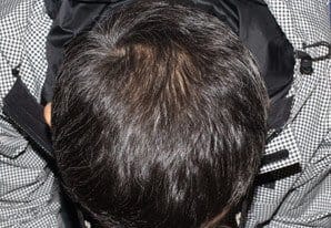 植毛手術５ヶ月後 38歳 男性 H.Y.さん頭頂部 MIRAI法 2,700株 東京 新宿院